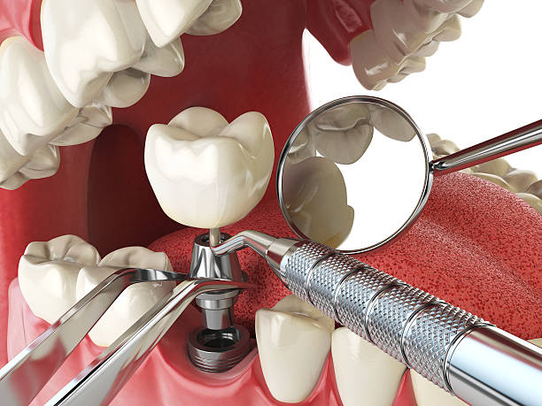Best Emergency Dental Care for Broken or Chipped Teeth in Kalona, IA