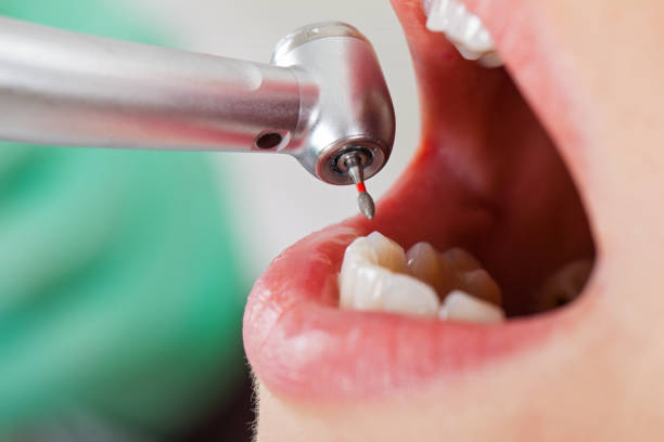 Best Emergency Tooth Extraction in Kalona, IA